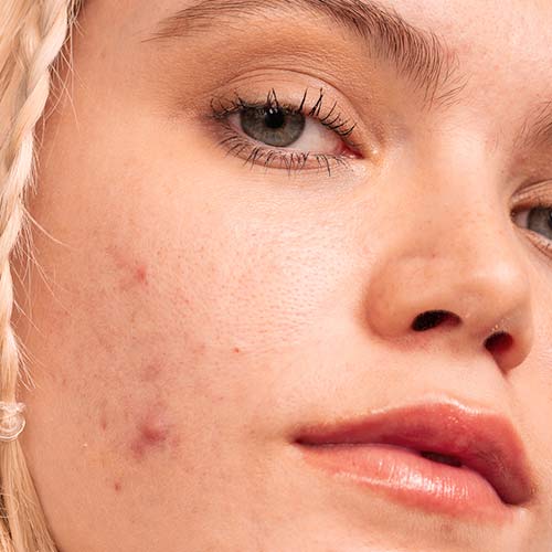 acne and breakouts